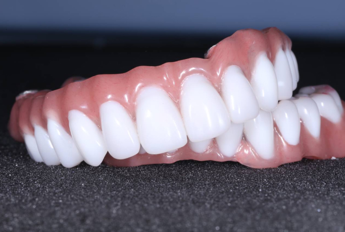 Постоянные зубы после имплантации — возможны!
